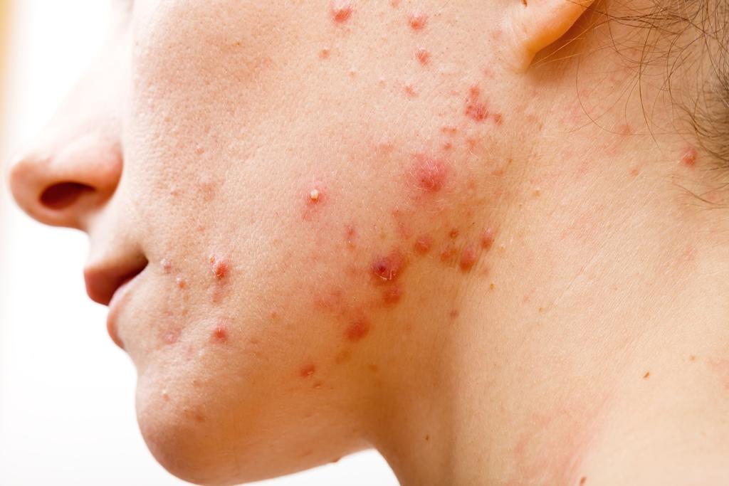 các loại mụn