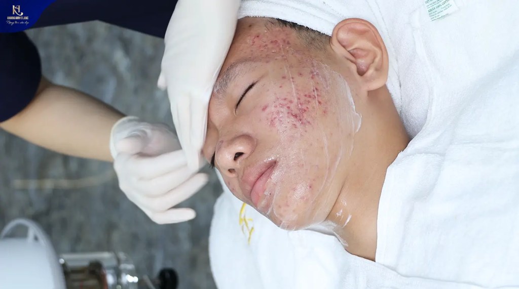 Các loại mụn tuổi dậy thì
